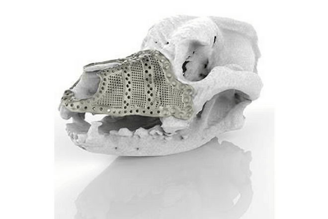implante en 3D de titanio